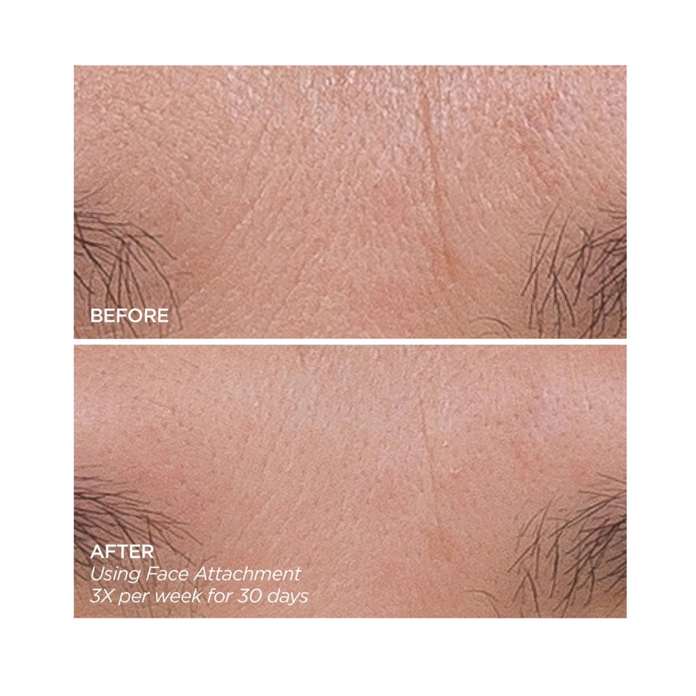 BEAUTYBIO GloPRO Facial Microneedling Tool - Picture 4 of 4